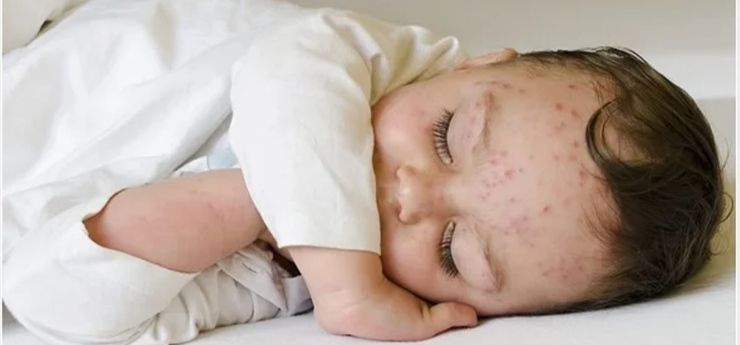 Childhood Infections